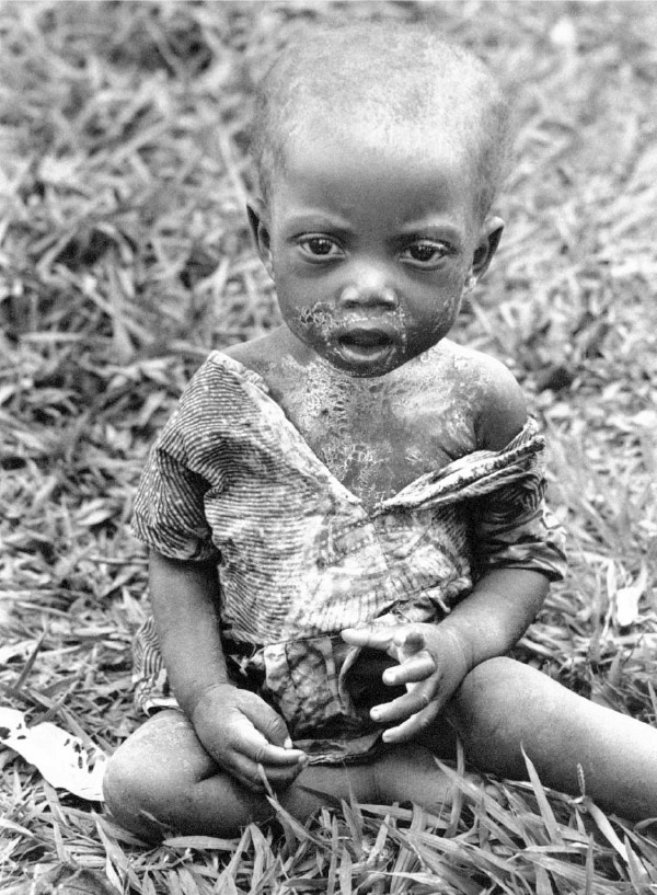 1961 m. sausio 26. Sergantis ir alkanas Balubos vaikas nufotografuotas Miabi ligoninėje. Nuotrauka: AP - Horst Faas
